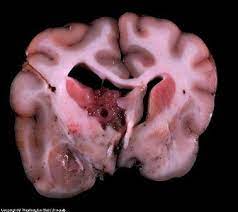 How common is cancer in dogs, and what are some of the common cancers found in dogs? Treatment Of Dog Brain Tumor Symptoms