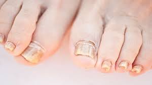 The black lines on nails are narrow vertical lines underneath the nails. Is It Toenail Fungus Or Something Else Everyday Health