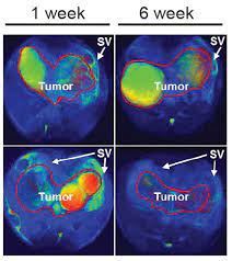 There is no known direct link between alcohol and prostate cancer risk. Research Finds Achilles Heel For Aggressive Prostate Cancer