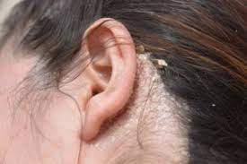 Do You Have An Itchy Scalp 5 Common Problems And Fixes Health Essentials From Cleveland Clinic