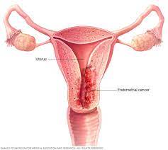 When cancer starts in the uterus, it is called uterine cancer. Endometrial Cancer Symptoms And Causes Mayo Clinic
