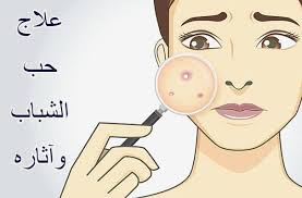 أفضل علاج لحب الشباب وآثاره بدون وصفات طبية Family Guy