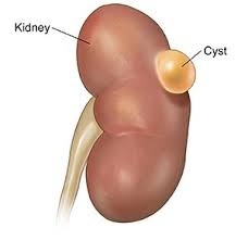 Por Que Quistes Renales Ocurren Sobre Todo En Personas Mayores Y Ancianos Kidney Cyst Chinese Medicine Cysts