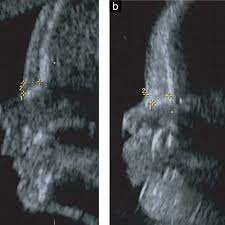 Ultrasound Images Of A Normal Fetus A And A Fetus With Trisomy 21 B Download Scientific Diagram