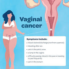 A cancer may also cause symptoms like fever, extreme tiredness (fatigue), or weight loss. What Is Gynaecological Cancer And What Are The Symptoms Queensland Health
