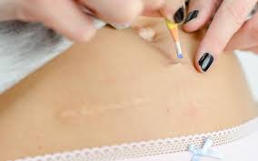 Take three aspirin tablets, a. What To Do When You Have Ingrown Hair
