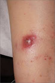 Image result for infected tick bite