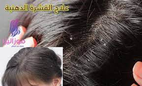 علاج قشرة الشعر الدهني بطريقة مضمونة 2019 Beauty Lockscreen
