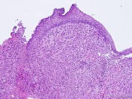 Image result for Pyogenic Granuloma