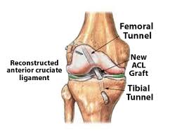 You might set up network acls with rules. Anterior Cruciate Ligament Acl Reconstruction Autograft Includes Implants Hardware St George Surgical Center
