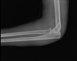 Image result for Coronoid Process Fracture