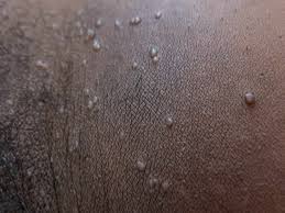 Image result for genital herpes