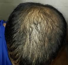 But if you cannot find any new growth or if the thinning gets worse, it's better to see a dermatologist. Can Dead Hair Follicles Regrow By Prp Hair Loss Treatment Photos