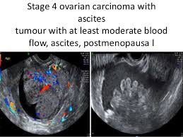 A radiologist—a physician who specializes in diagnosing. Role Of Ultrasound In Ovarian Lesions