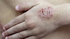 Image result for Eczema nummulare