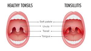 Image result for Tonsillitis