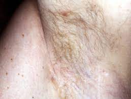 See more ideas about toenail fungus, toenail fungus cure, toenail fungus treatment. Trichomycosis Axillaris Dermnet Nz