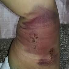 Side effects after nexplanon removalall education. Woman Goes Through Hell With Implanon Birth Control Implant Health24