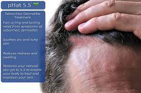 On the off chance that you have seborrheic dermatitis and notice hair loss, fix a meeting with your doctor. Buy Sulfate Free Shampoo And Conditioner Set For Seborrheic Dermatitis Relief Severe Dry Itchy Scalp Treatment With Manuka Honey Aloe Vera Coconut Oil Safe For Color Treated Hair