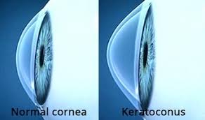 Today there are various hypotheses about why keratoconus occurs, but the exact causes and trigger mechanism of this disease are still not fully established. Koetting Eye Center Managing And Treating Dry Eye Disease