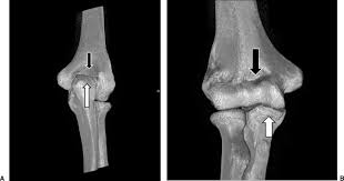 …this notch is called the olecranon process; A Olecranon Fossa With The Elbow In Extension The Tip Of The Download Scientific Diagram