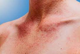 Slideshow 9 Things You Could Be Allergic To Heat Rash Skin Allergies Sun Poisoning Rash