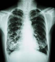 Before a cancer cell dies it gets sick. Study Finds Evidence That The Presence Of Emphysema On A Ct Scan Increases Lung Cancer Risk