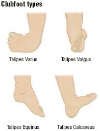 Most clubfeet can be successfully corrected using the nonsurgical ponseti method. Clubfoot What Is Clubfoot What Causes Clubfoot Who Gets Clubfoot What Are The Symptoms Of Clubfoot