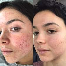 How To Treat Hormonal Acne Without Birth Control Health Com