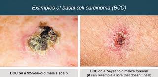 However, once the cancer has spread to the lymph nodes, or metastasized to other part of the body, the outcomes are much worse. Basal Cell Carcinoma Healthdirect