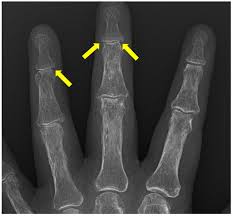 Image result for XRay Changes in Rheumatic Conditions