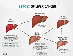 What are the types of liver cancer? Liver Cancer Treatment Risk Symptoms And Causes Ailbs