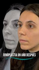 En nuestra clínica, trabajamos de forma integral con nuestras Cosmiatrias Nancy  Alvaro y Julia Sánchez 🔅 Solicita tu turno 👇 📱 261 710-5311 📧  info.rinoplastiamendoza@gmail.com Mejora tu piel con profesionales  especializadas. 💫 ¡
