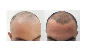 La tecnica microfue è il metodo più avanzato e all'avanguardia di trapianto di capelli. Trapianto Di Capelli Dona Volume E Nuova Vita Ai Tuoi Capelli Skinlaser