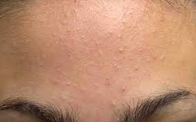 Jerawat atau acne vulgaris merupakan perkara yang biasa berlaku pada remaja yang akhir baligh disebabkan oleh perubahan hormon badan. Amani Younglivingmelaka Cara Hilangkan Parut Hitam Jerawat