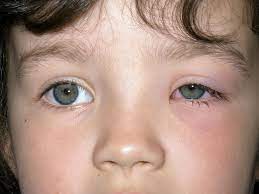 Periorbital Cellulitis Babycenter