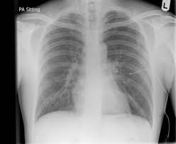 It is considered a simple pneumothorax when there isn't any mediastinal shift to th. Spontaneous Pneumothorax Radiology Case Radiopaedia Org