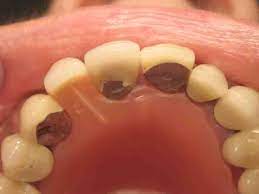 Maybe you would like to learn more about one of these? Why Wear A Denture When You Can Have An Implant Bank House Dentistry News