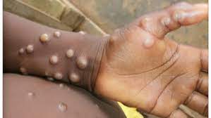 Public health wales has confirmed the initial case was picked up abroad. United Kingdom Reports Two Cases Of Monkeypox Initiates Contact Tracing Latest News India Hindustan Times