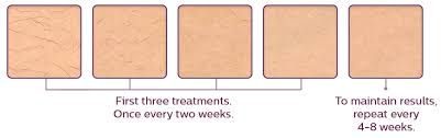 Read honest and unbiased product reviews from our users. Lumea Ipl Hair Removal System Philips
