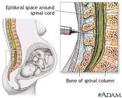Anestesia Epidural Durante El Parto Y Complicaciones En El Recien Nacido Es Oro Todo Lo Que Reluce Anestesiar