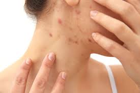 Image result for scabies symptoms