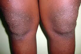 Image result for Keratosis pilaris