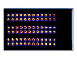 Image result for Nuclear Ventriculogram