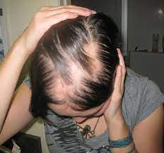 Lupus erythematosus), which are associated with autoimmune thyroid diseases. Thyroid And Hair Loss Hyperthyroidism Hypothyroidism