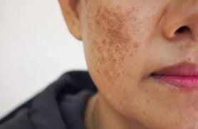 Crema De La Campana Para Manchas De La Cara Y Piel : Amazon.Com.Mx: Belleza