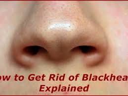 Check spelling or type a new query. How To Get Rid Of Blackheads Bellatory