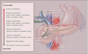The pancreas is an organ deep inside holden's pancreatic cancer experts can treat every kind of patient, including the ones who need the. Pancreatic Adenocarcinoma Nejm