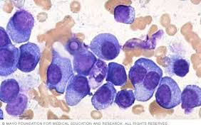 Image result for Multiple Myeloma