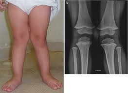 Most children who have knock knees grow out of the condition. Common Orthopedic Problems In Children Springerlink